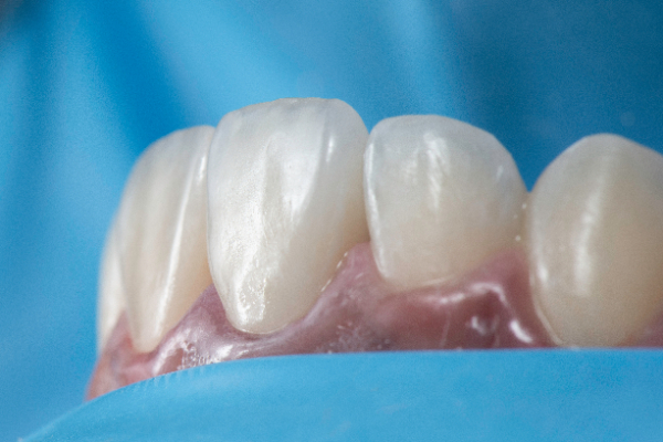 Most Common Types Of Dental Bonding Treatments