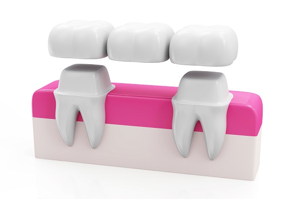 Caring For And Maintaining Your Dental Bridge