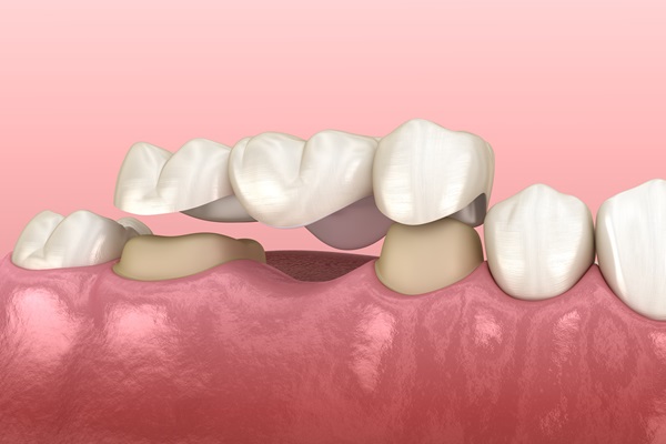 When Is A Dental Bridge Recommended To Replace A Missing Tooth?