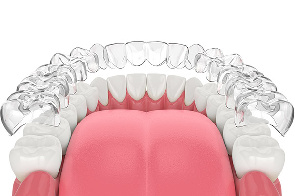 Do You Still Need Dental Care During Clear Aligners Treatment?