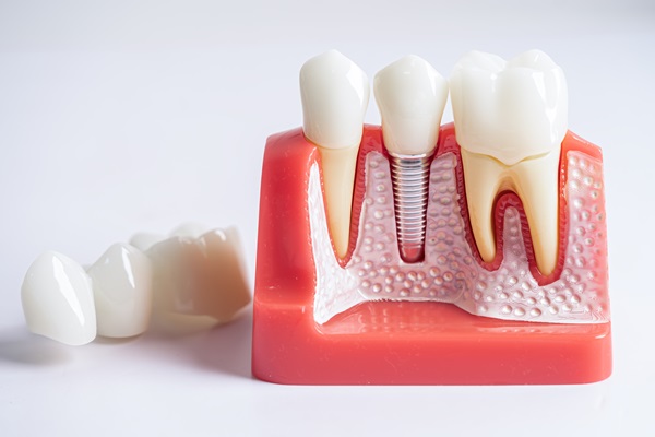 How The Dentist Prepares Teeth For Dental Crowns