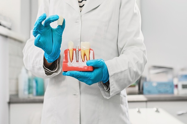 Top   Benefits Of Choosing Dental Implants For Missing Teeth