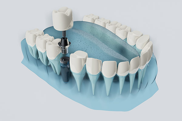 FAQs about Dental Implants from Metcalf Dental in Oak Brook, IL