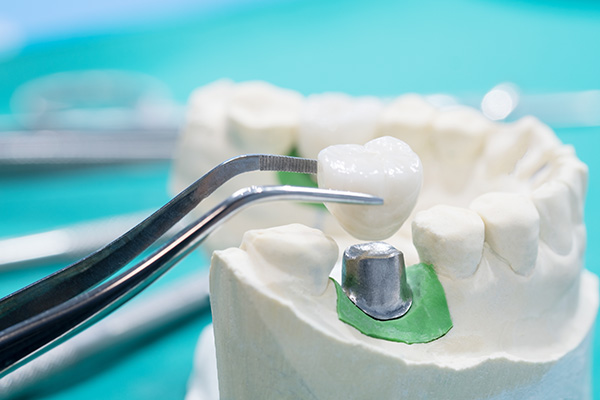 General Dentistry Solutions Using Dental Crowns from Metcalf Dental in Oak Brook, IL