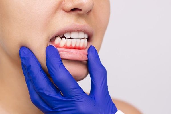 A Dentist Explains The Dangers Of Gum Disease